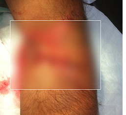 Click to view the unedited photo of the climber's arm after treatment