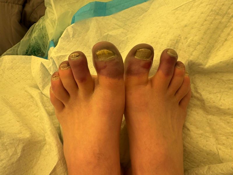 Climber's toes with frostbite on the top