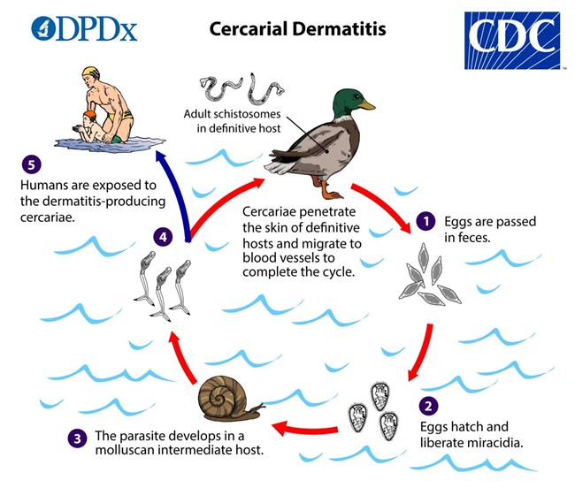 A flow chart showing how parasites infect birds, develop in snails, and then cause allergic reactions in humans.