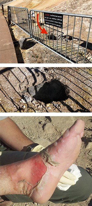Top: A waist-deep hole remains where an individual broke through a thin crust at Sulphur Works after stepping around the barrier. Bottom: The badly burned foot of a visitor who traveled off-trail in Devils Kitchen hydrothermal area.