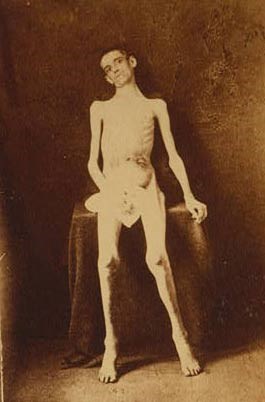 An emaciated inmate of Andersonville Military Prison.